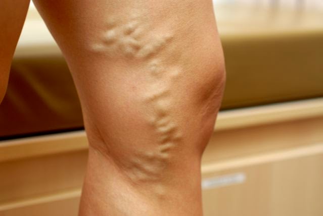 No curan las heridas a la tromboflebitis